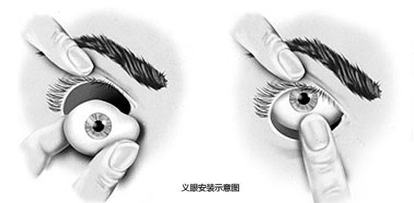 真假難辨，義眼移植術(shù)帶你重拾自信